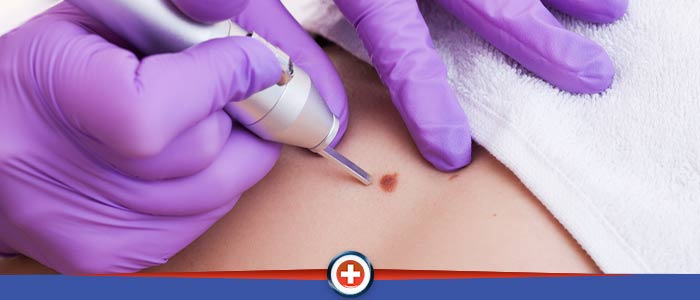 Removal of Sebaceous Cysts and Benign Skin Lesions Near Me in Cincinnati OH Removal of Sebaceous Cysts and Benign Skin Lesions Near Me in Cincinnati OH