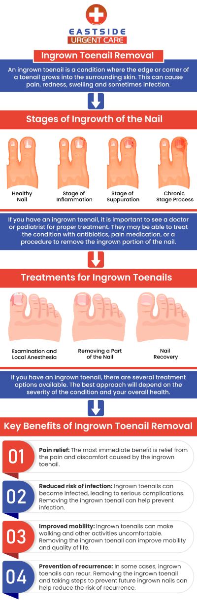 An ingrown nail happens when the nail grows into the skin or when the skin on one or both sides of the nail grows over the nail's edges. An ingrown toenail may initially be painful, large, and rigid. Later on, it could feel really painful and get red and infected. Ingrown toenail removal treatment is available at Eastside Urgent Care. For more information, contact us or book an appointment. You can also visit us online to get directions to our clinic. We are conveniently located at 872 Ohio Pike, Cincinnati, OH 45245. An ingrown nail happens when the nail grows into the skin or when the skin on one or both sides of the nail grows over the nail's edges. An ingrown toenail may initially be painful, large, and rigid. Later on, it could feel really painful and get red and infected. Ingrown toenail removal treatment is available at Eastside Urgent Care. For more information, contact us or book an appointment. You can also visit us online to get directions to our clinic. We are conveniently located at 872 Ohio Pike, Cincinnati, OH 45245.